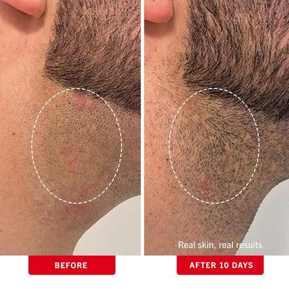 First Aid Beauty - Ingrown Hair Pads with BHA + AHA - Aftershave Treatment Pads to Help Prevent Razor Bumps for Men & Women - Exfoliate Underarms & Bikini Area - Compostable for Daily Use - 28 Pads